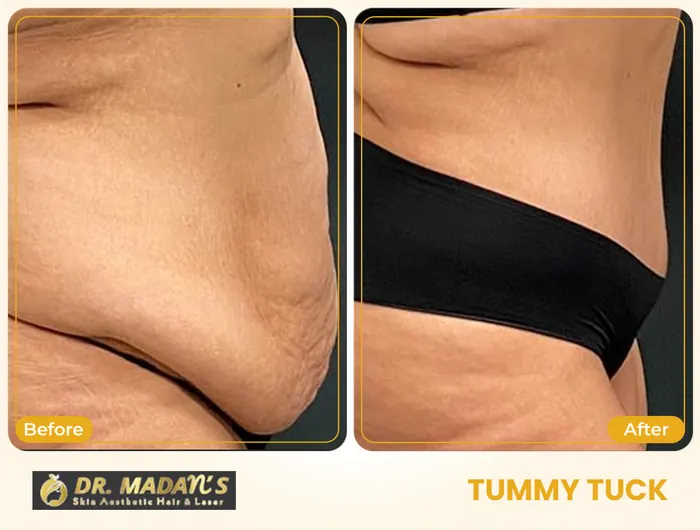 Tummy tuck before and after result 2 at Dr Madan Aesthetics